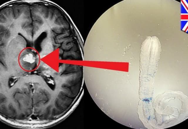  Ngeri, Ada Cacing di Bagian Otak Pria Ini 