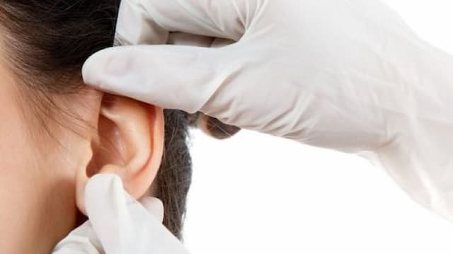 Punya Lubang Kecil di Atas Telinga? Bisa Jadi Sinus Preauricular